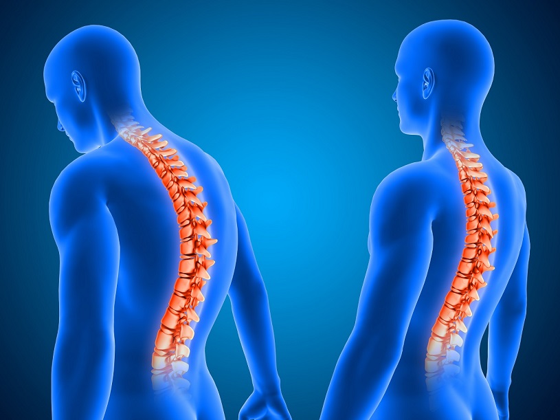 脊椎側彎會造成痠痛壓迫神經